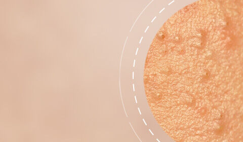 Close-up of textured skin, showing small bumps and variations in tone, set against a soft, blurred background.