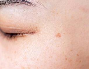 Primer plano de una piel facial con un tono saludable y algunas manchas pequenas, mostrando texturas y un ojo cerrado.