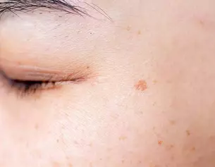 Primer plano de una piel facial con un tono saludable y algunas manchas pequenas, mostrando texturas y un ojo cerrado.