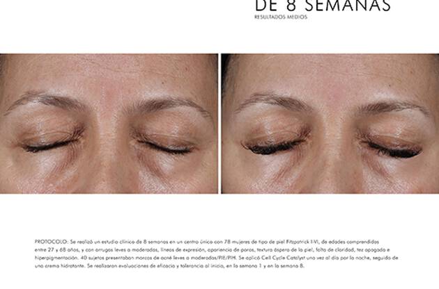 Imagen que muestra el antes y despues de un tratamiento en los ojos tras 8 semanas. Mejoria visible en la piel.