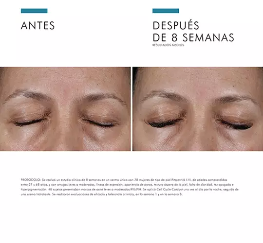 Imagen que muestra el antes y despues de un tratamiento en los ojos tras 8 semanas. Mejoria visible en la piel.