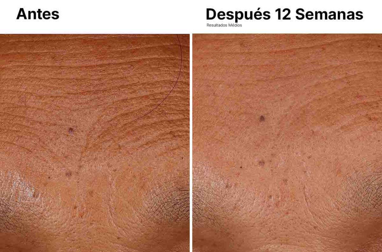 Comparativa de piel: imagenes del antes y despues de un tratamiento despues de 12 semanas, mostrando mejora en textura y arrugas.