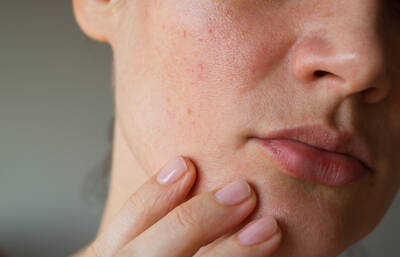 Causas-De-Las-Manchas-Skinceuticals-1