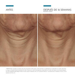 Tripeptide-R Neck Repair