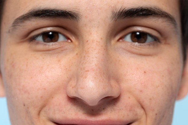 causas melasma