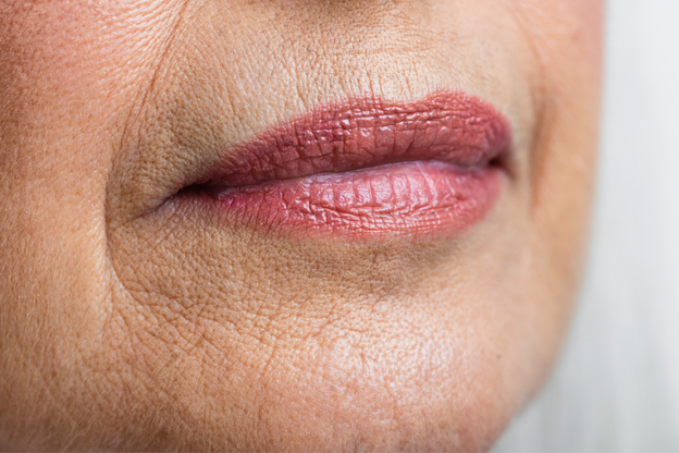 arrugas labio superior
