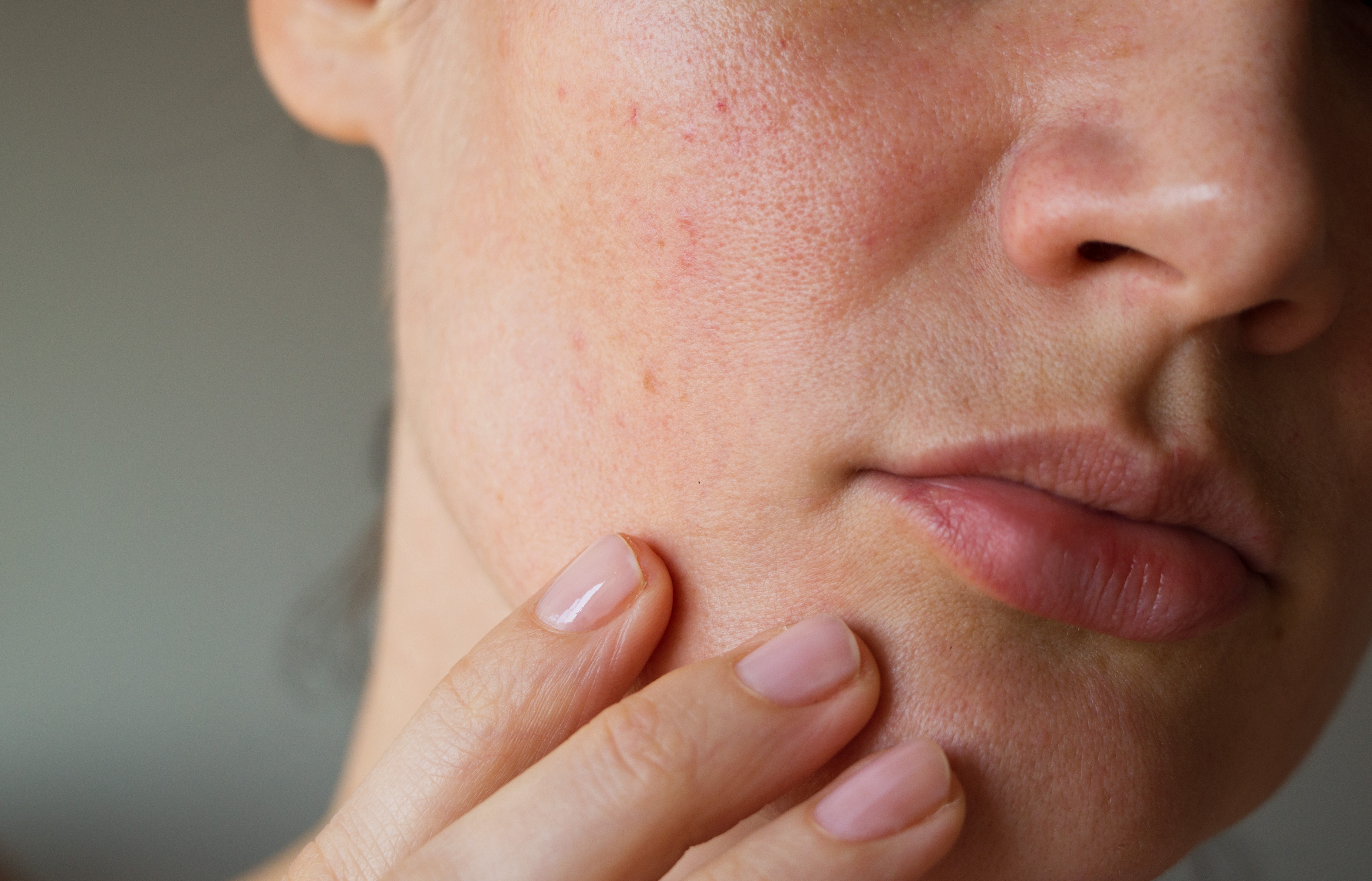 Manchas en la Cara: Tipos, Causas y Tratamientos | Skin-C Mag