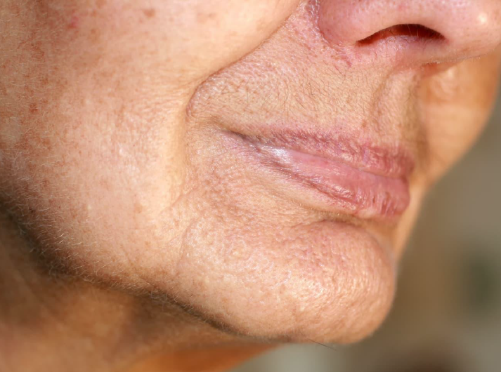 descolgamiento-facial-soluciones