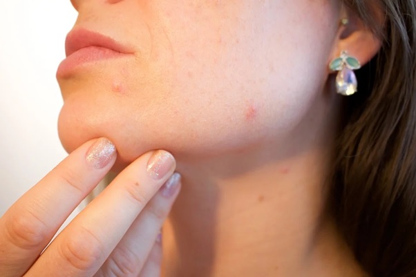 Como-Evitar-El-Acne-Skinceuticals-2